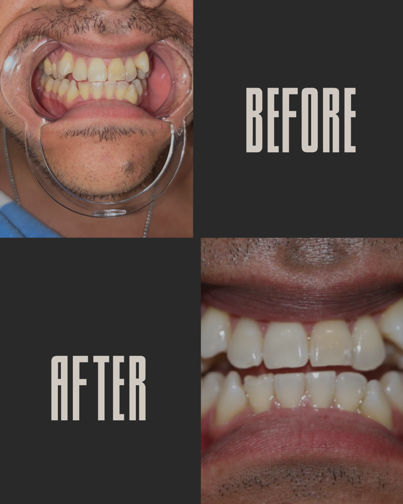 60 mins teeth whitening session