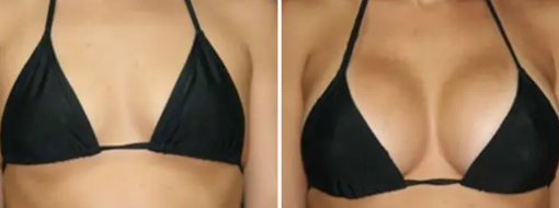 BREAST ENHANCEMENT