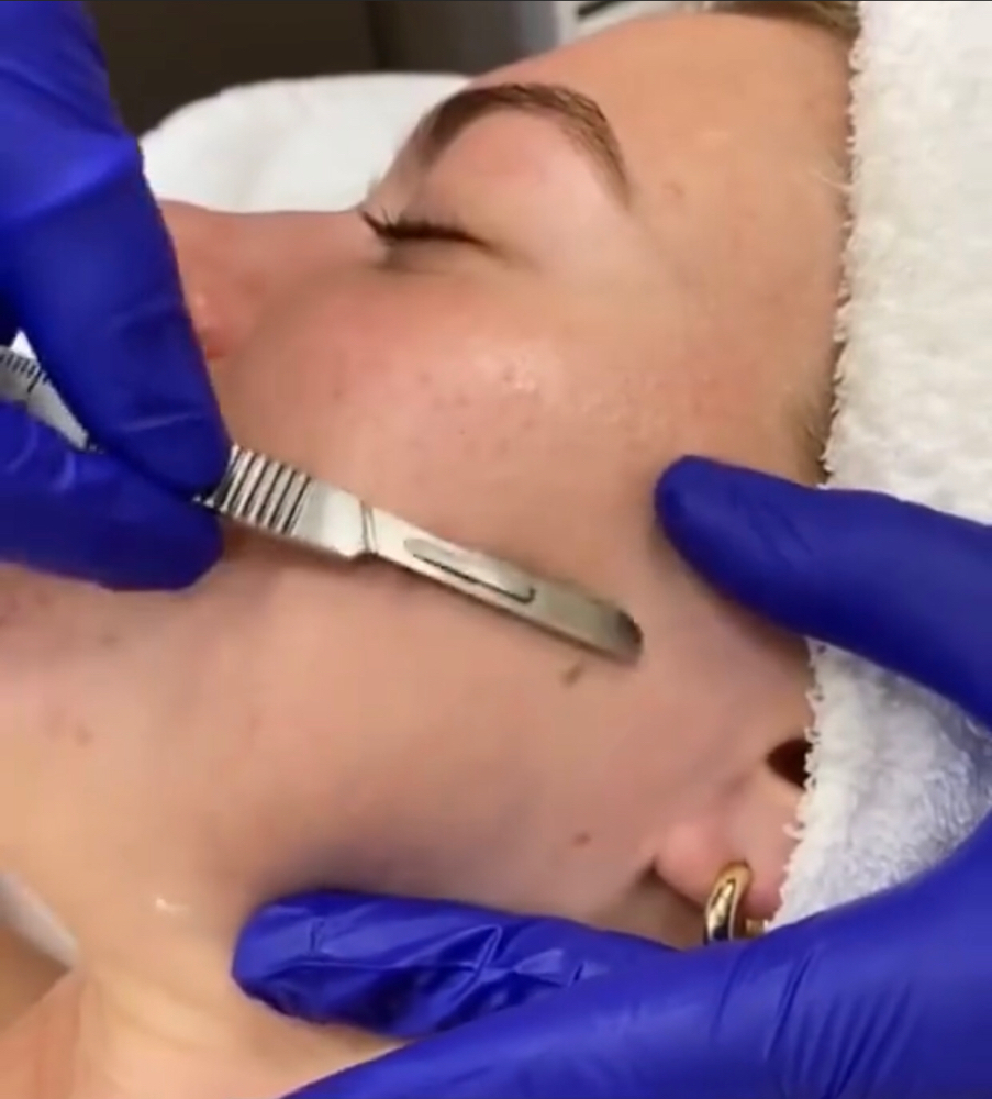 Best Dermaplanning