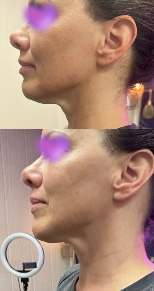 Brazilian Face Lift at Swani Massage and Bodywork in Fort Worth, TX