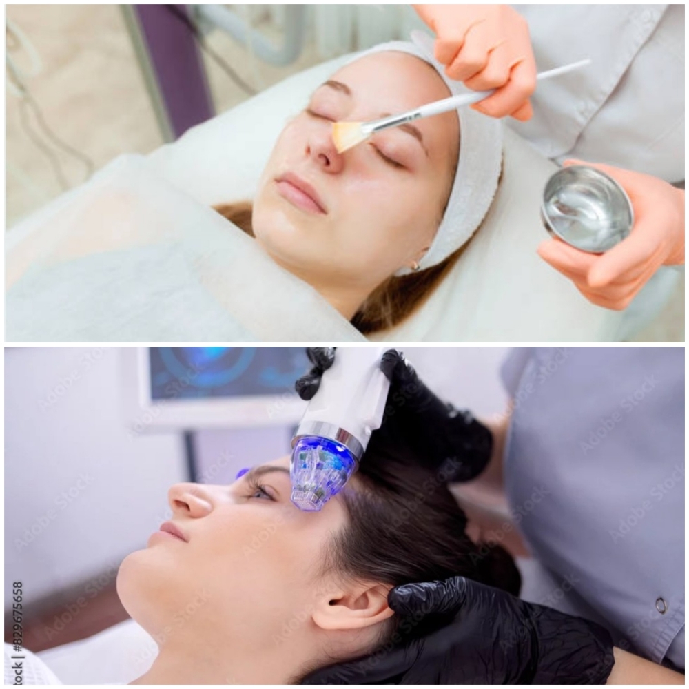 Rf Microneedling & Chemical Peel