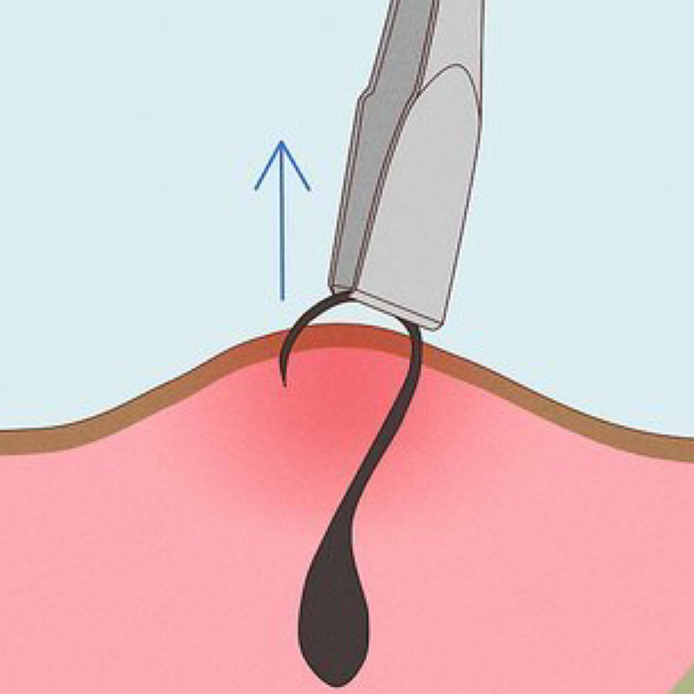 Ingrown extraction - No Waxing at Elevated By Nessa in Williston, ND