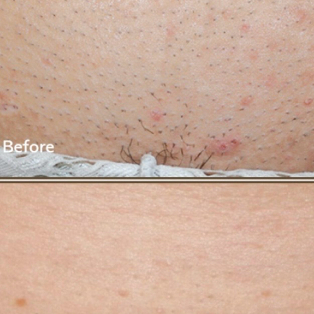 Laser Hair Bikimi at Merry Spa in Huntington, NY