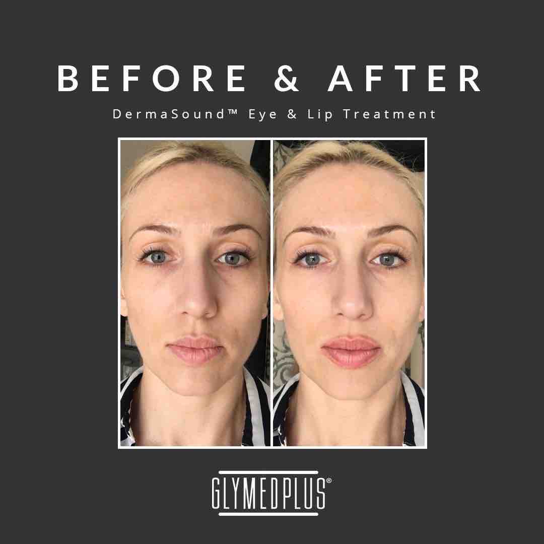 Dermasound Facial