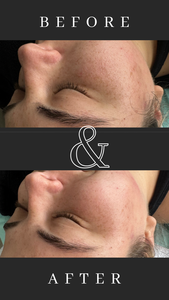 Dermaplane + No Downtime Peel