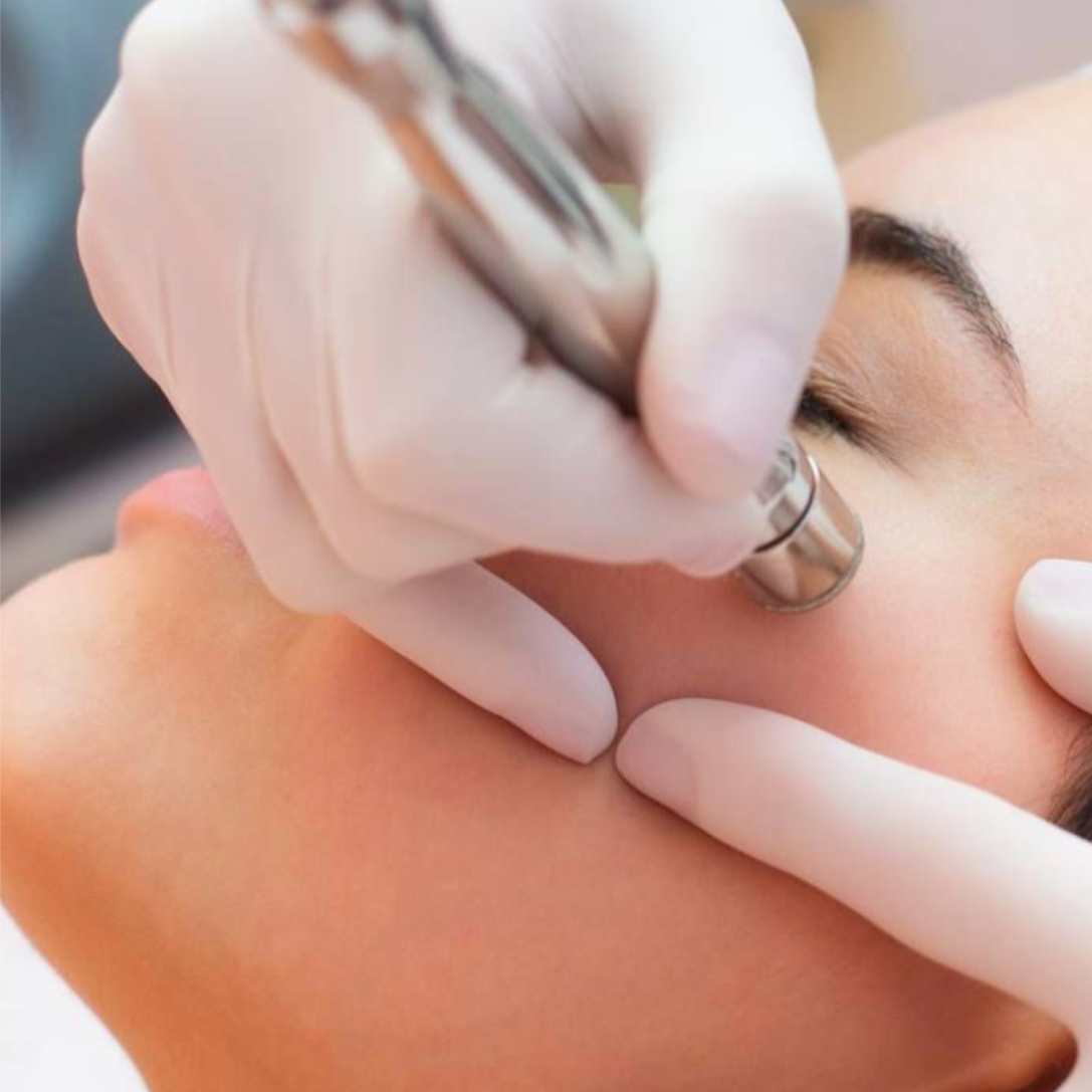 Microdermabrasion at Nola Estheticis in Marrero, LA