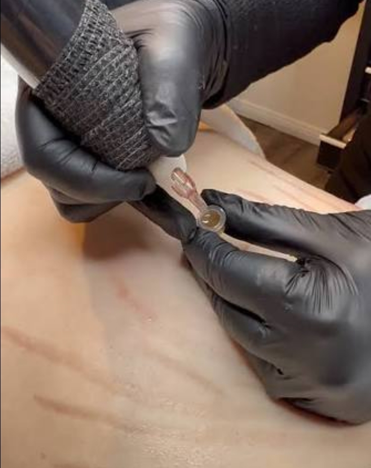 INKLESS STRETCHMARK - SCAR REVISION