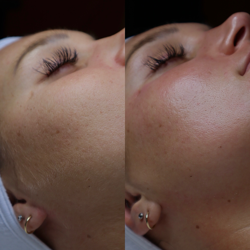 Dermaplane Facial