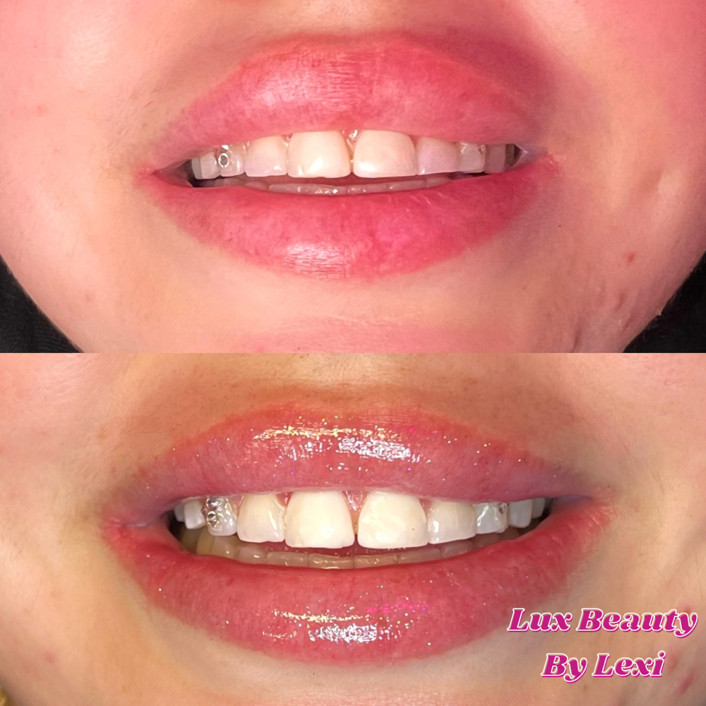 Teeth Whitening + 1 Tooth Gem