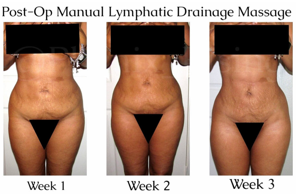 6 Pkg Post Op/ Body Sculpting