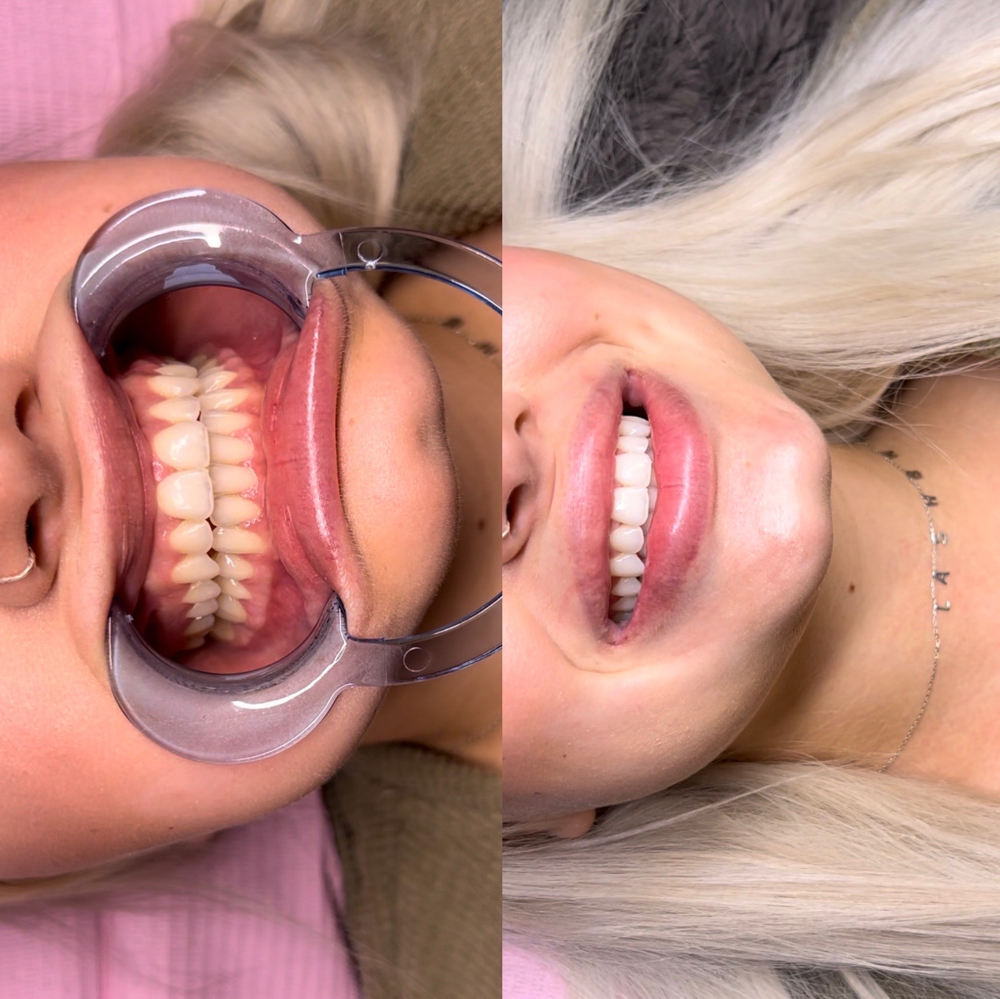 Teeth Whitening