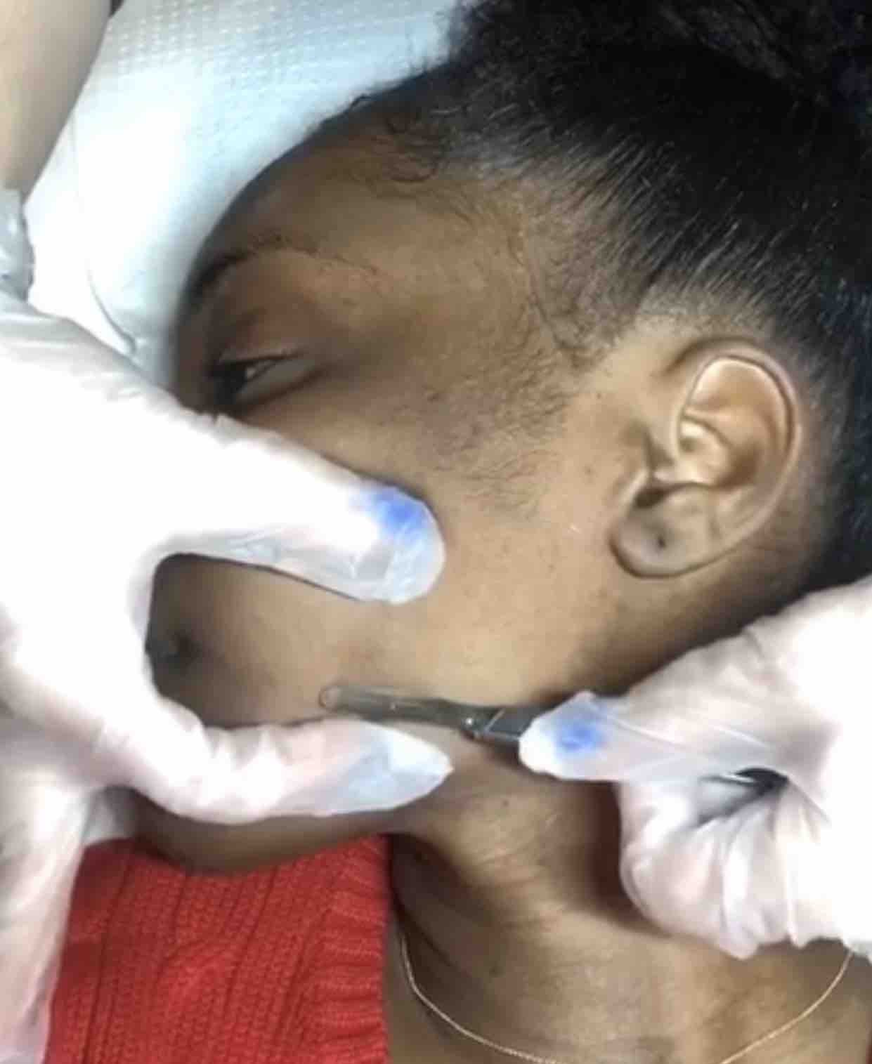 Dermaplanning