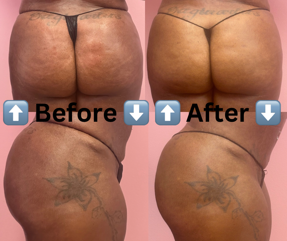 Non Surgical BBL at Get Waisted By MJ in Marietta, GA