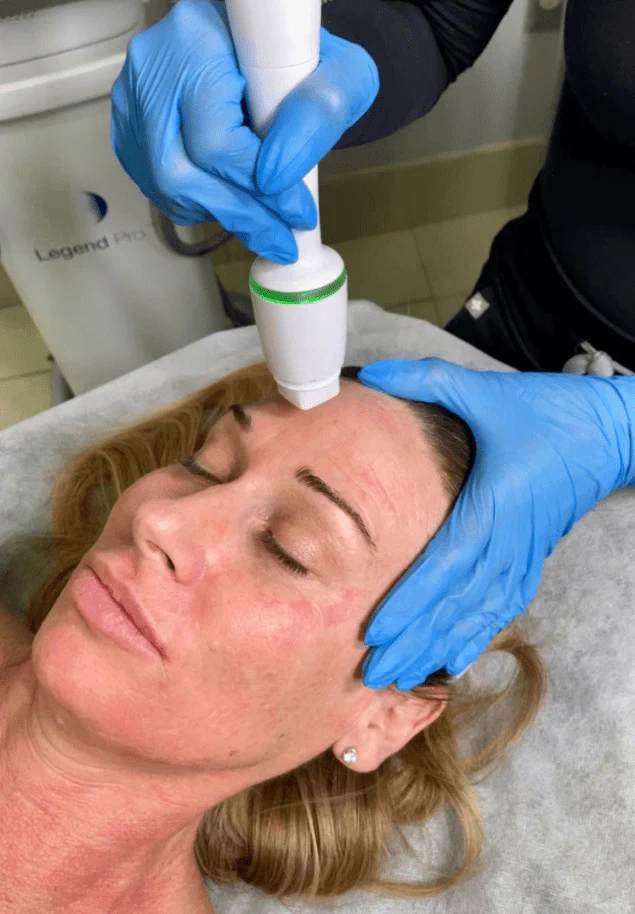 Voluderm (RF Microneedling)