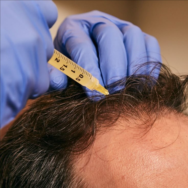 Hair Restoration Microneedling at Luxe Level Aesthetics in Darien, CT
