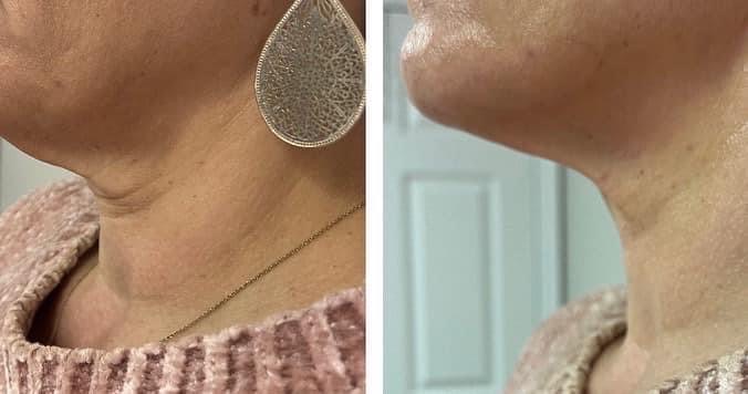 Body Contouring- Chin