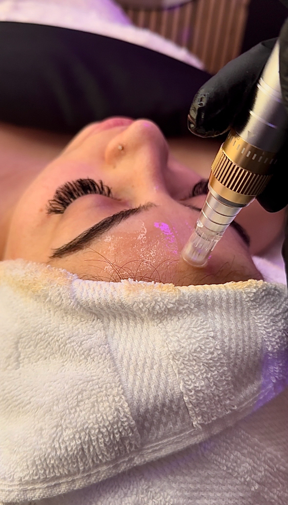 'Microneedling Glow'' Facial TrT