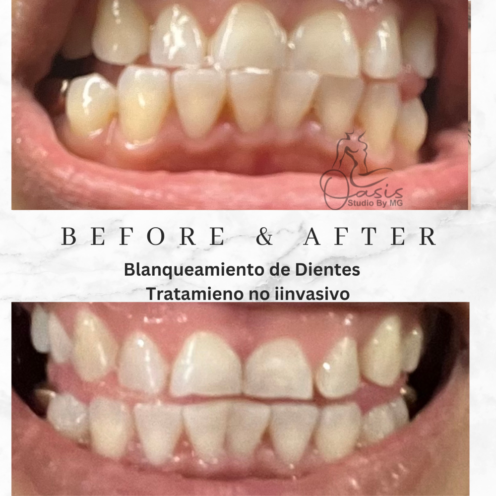 Blanqueamiento De Dientes