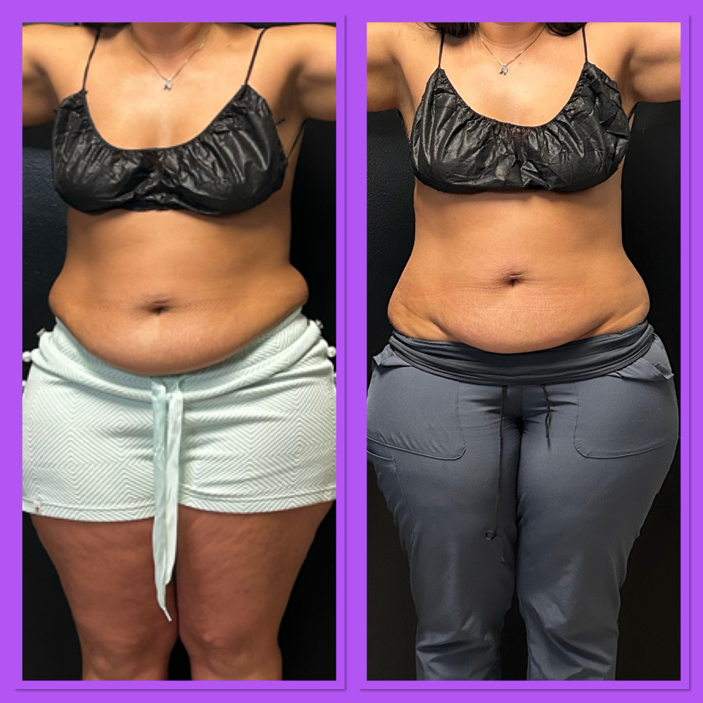 Non-surgical Body Works at Pure Essence Beauty & Body, LLC in Shreveport, LA