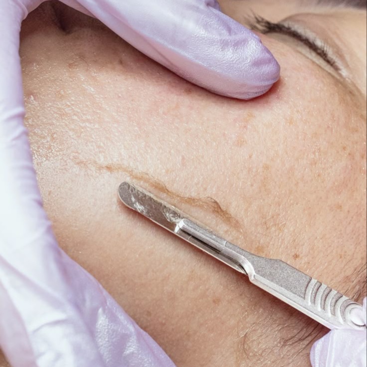 Dermaplane Facial at L.E.N Beauty Studio in Round Lake Park, IL