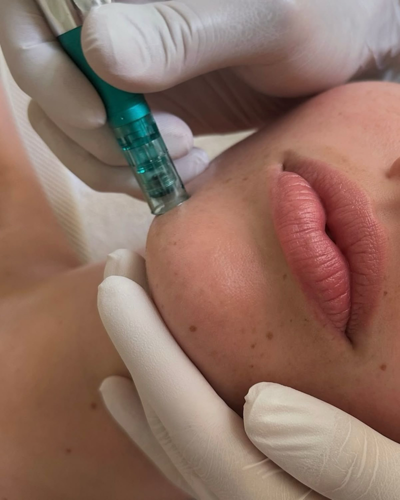 Microneedling Treatment