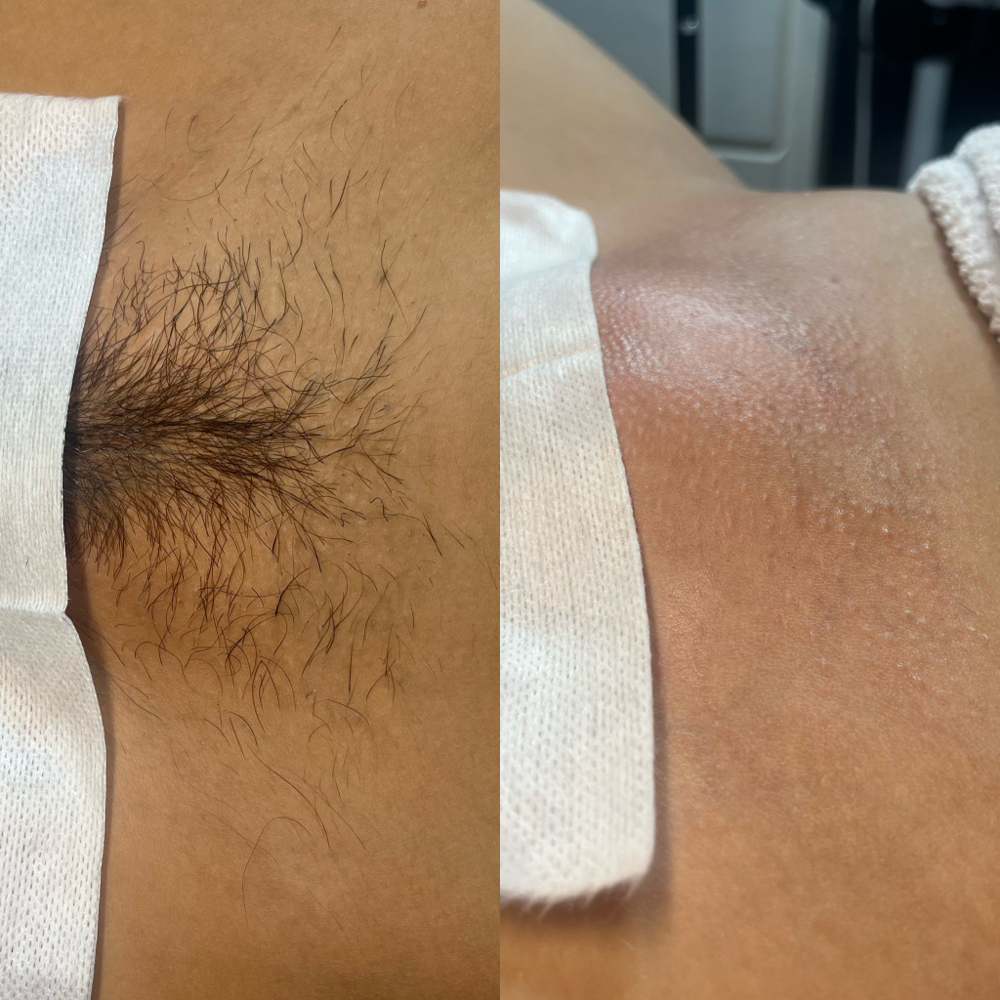 Full Brazilian Wax at Glow Lab by Bronte in Springfield, IL