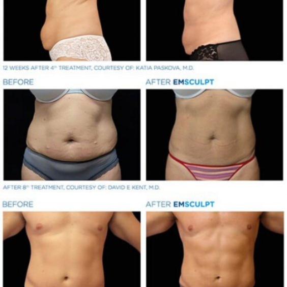 EMSCULPT Treatment at Facial Sensations in Lewisville, TX