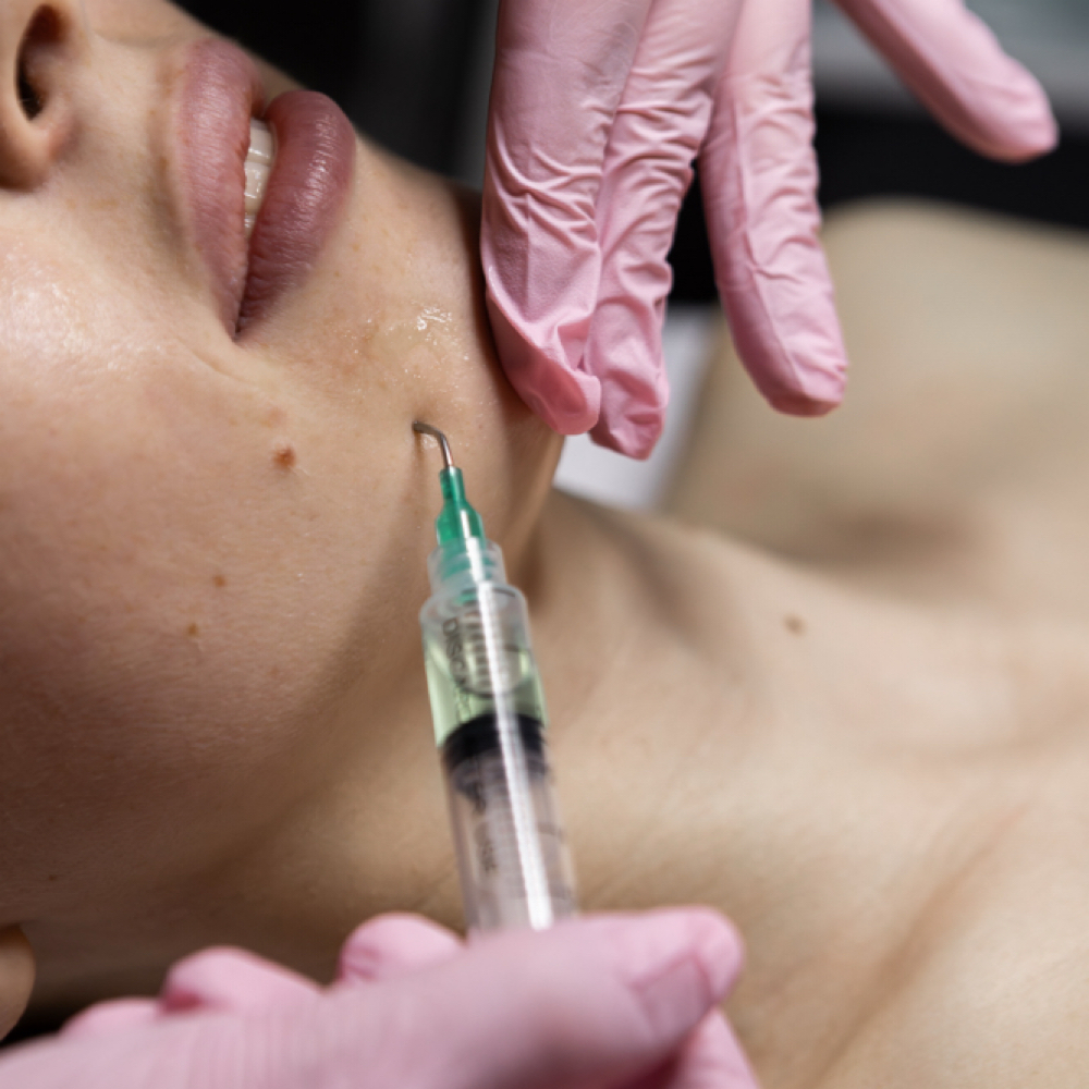 Microneedling&Exsosoms at Maryna Skin Studio in Chicago, IL