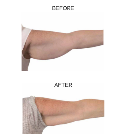 Arms Skin Tightening at JENNVIE Med Spa in Westport, CT
