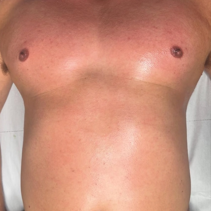 Full Chest & Back Wax