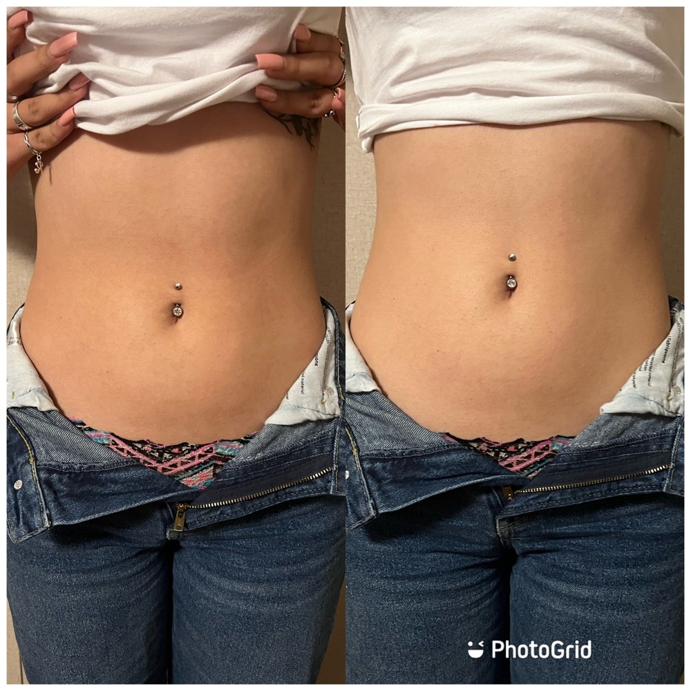 3 Areas Of Body Lipo at BeauTIFFul Modifications in Natalia, TX