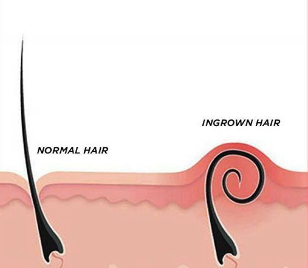 INGROWN TREATMENT - ONLY