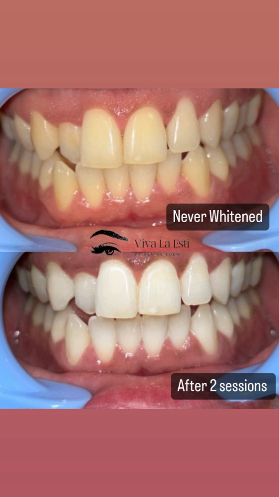 1hr Teeth Whitening