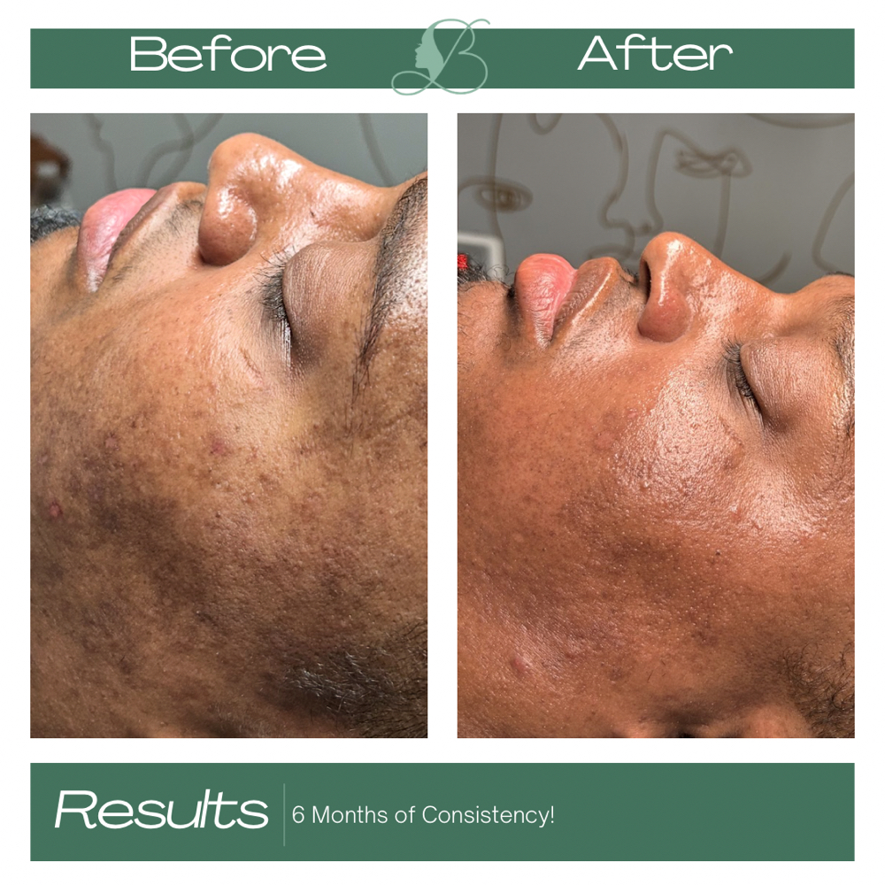 Even Tone Facial at Bree The Esti in Columbia, SC