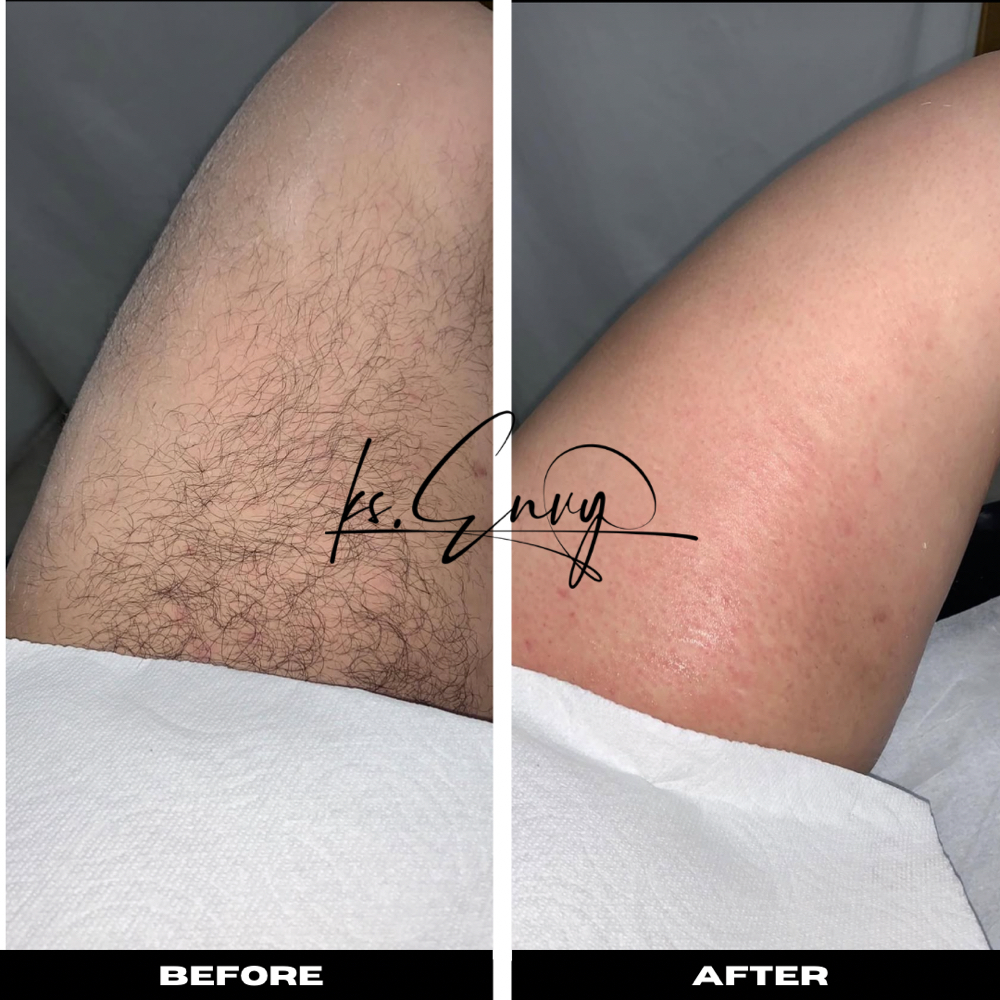 Thigh: Inner at KS.Envy in Columbus, OH