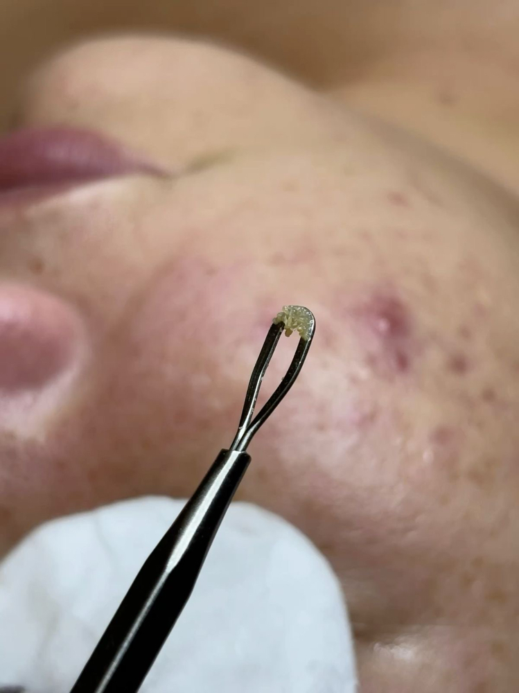 Acne Facial