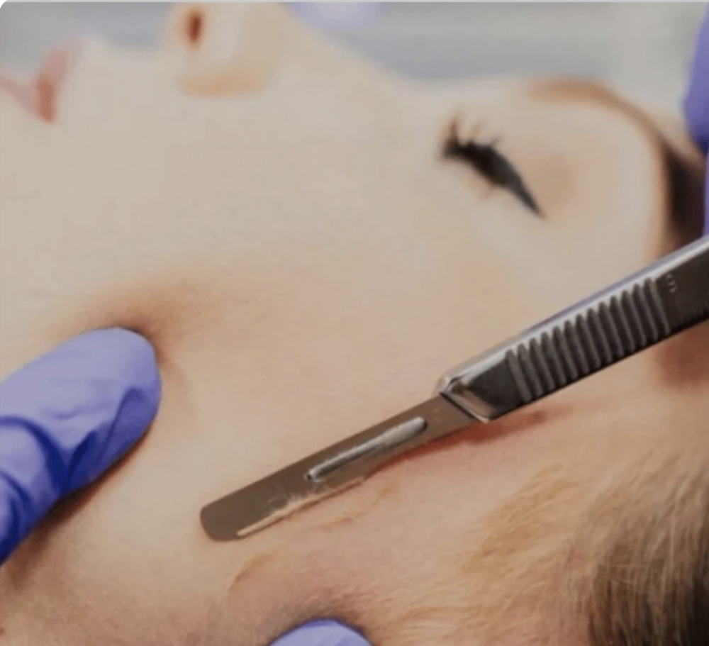 Dermaplaning Facial
