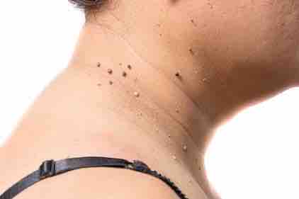 Skin Tag Removal