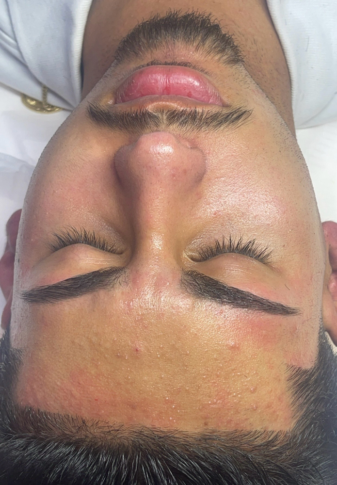 Acne Facial