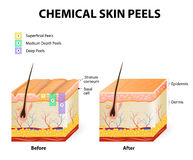 Lactic Peel