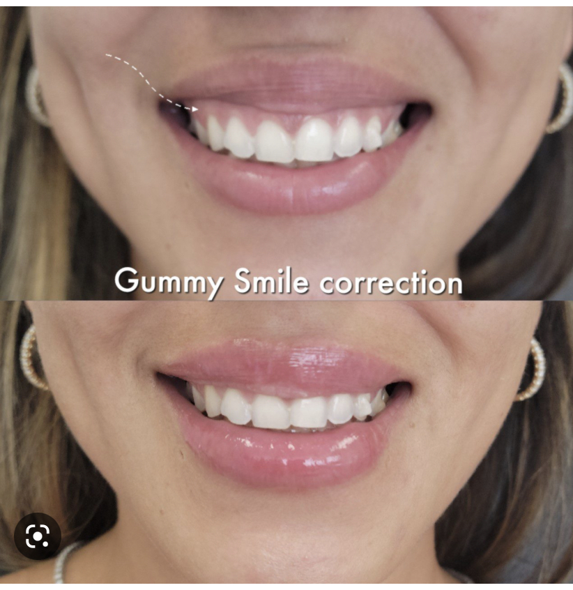 Gummy Smile Injection