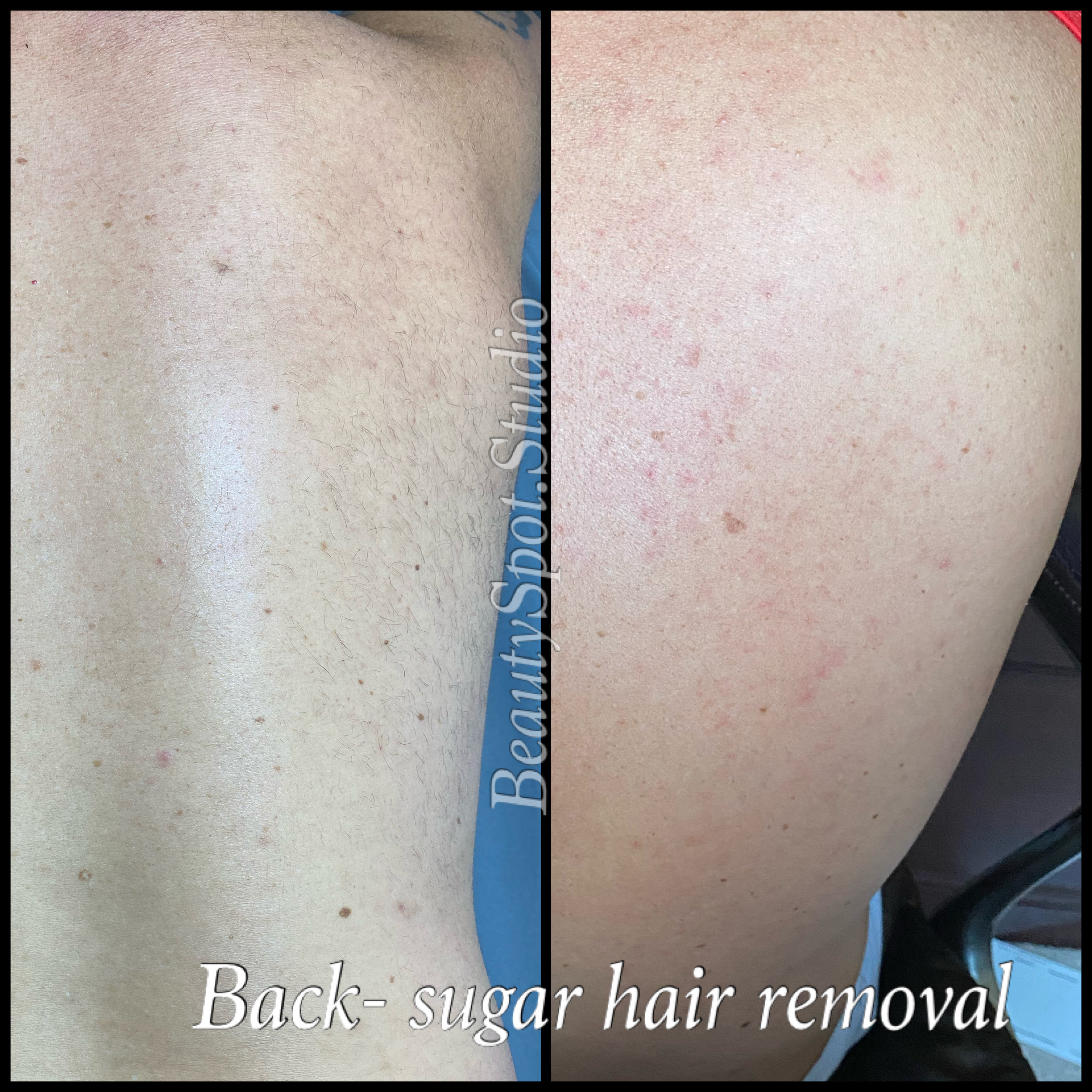 Full Back Hair Removal