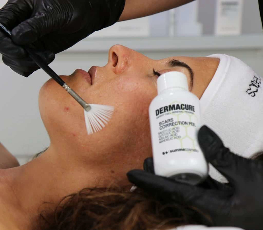 Scars Correction peel/ CicatrizAcné