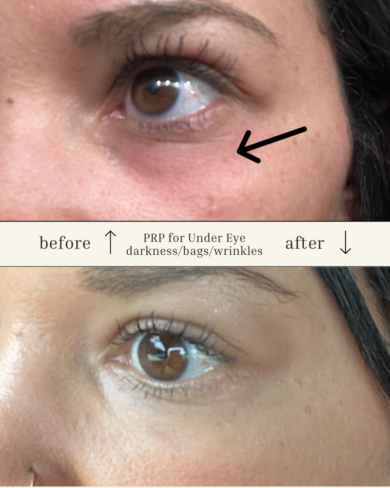 Under Eye PRP