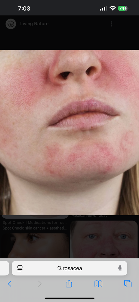 Rosacea Relief Facial Treatment