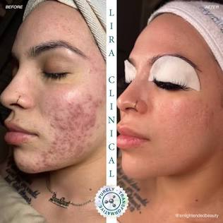 Hybrid Peel & Renew Facial