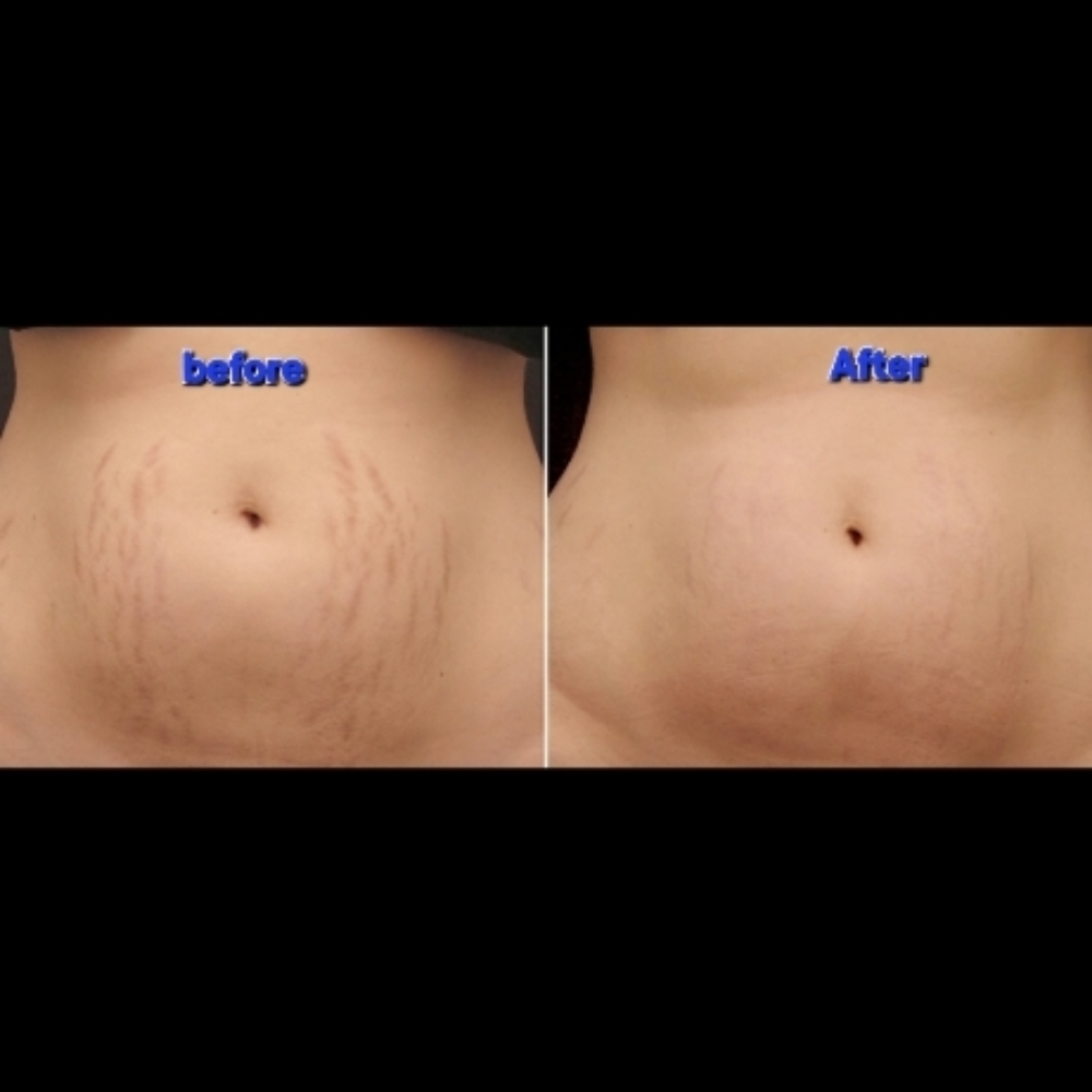 3 Stretch Mark Breakdown Bundle 3