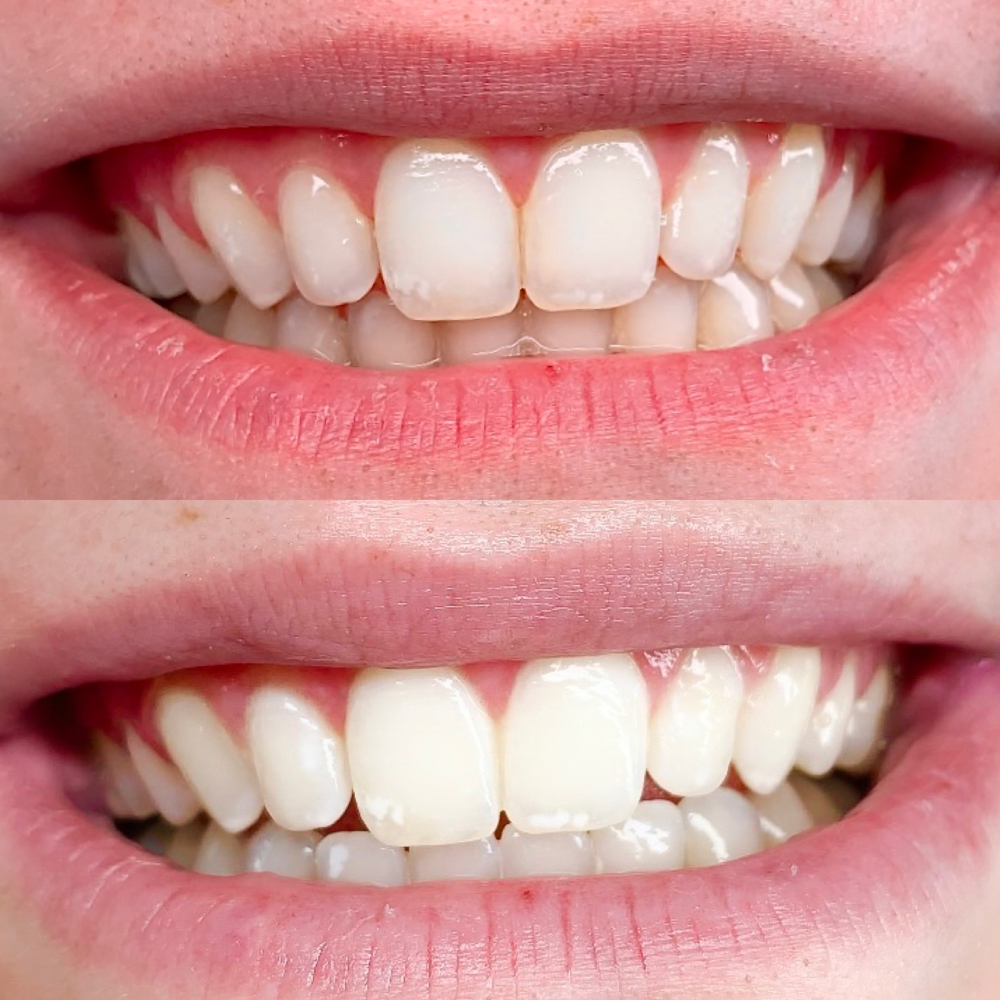 Teeth Whitening 3-6 Month Touch Up