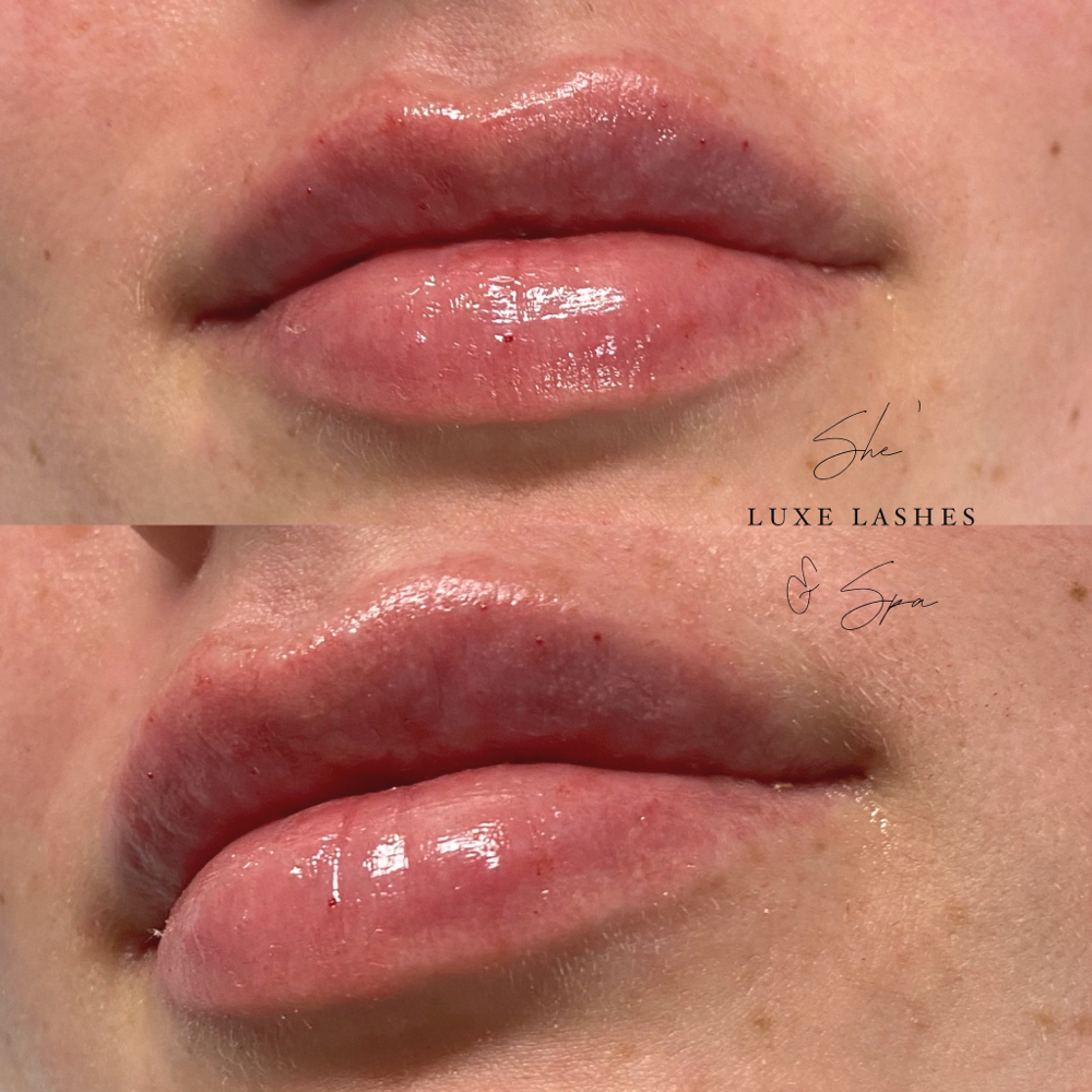 1 mL  Lip Filler at She’ Luxe Lashes in Greenville, NC
