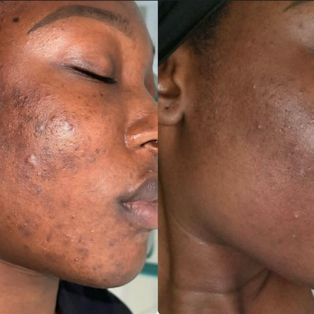 Organo Peel Consultation